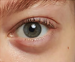 Puffy Eyes That Never Seem to Fade